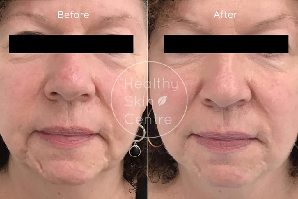 Pre and Post Dermal Filler 2, Healthy Skin Centre