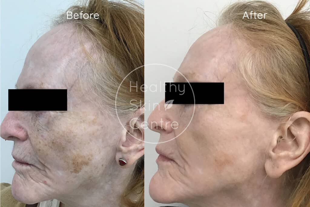 Pre and Post IPL 1, Healthy Skin Centre