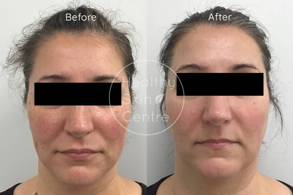 Pre and Post IPL 2, Healthy Skin Centre