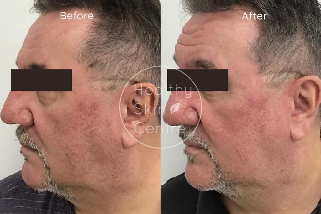 Pre and Post IPL 3, Healthy Skin Centre