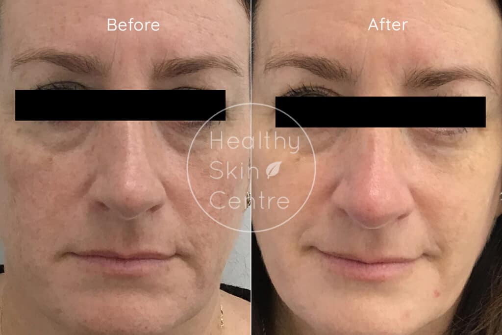 Pre and Post IPL 4, Healthy Skin Centre