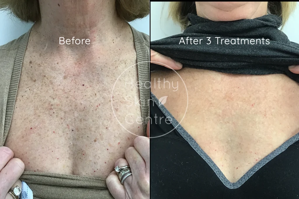 Before and after IPL treatment showing reduced redness and clearer skin tone.
