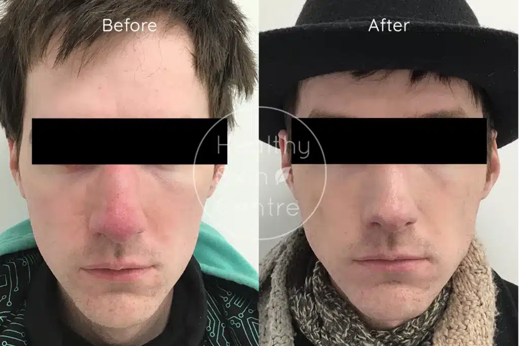 Before and after IPL treatment showing reduced redness, sun damage, and improved skin tone.