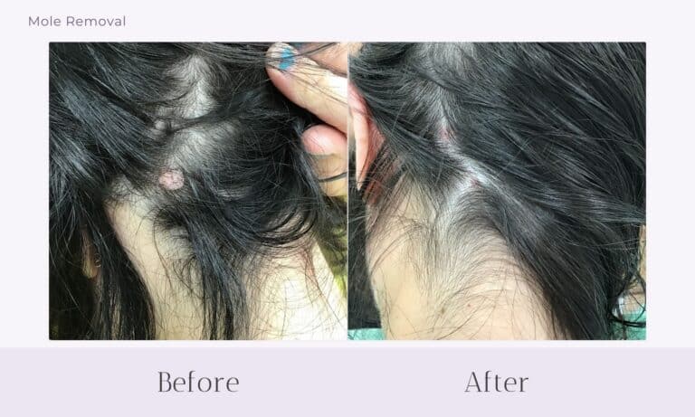 Before and after mole removal from back of head at Healthy Skin Centre
