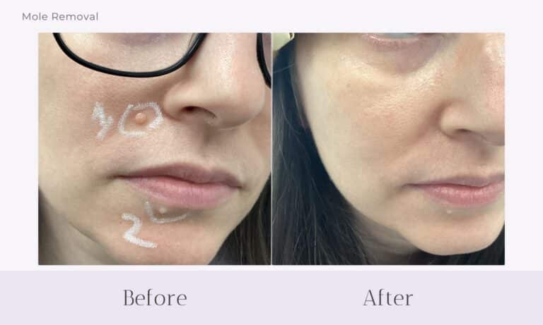 Before and after mole removal from cheek at Healthy Skin Centre