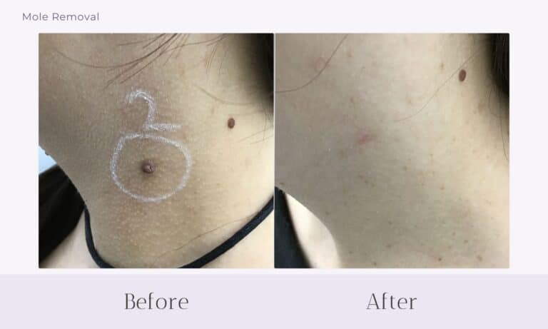 Before and after mole removal on neck at Healthy Skin Centre