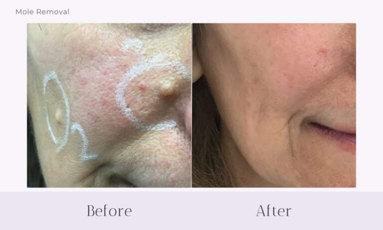 Before and after mole removals from cheek at Healthy Skin Centre