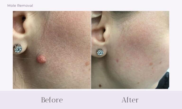 Before and after mole removal from cheek near ear at Healthy Skin Centre