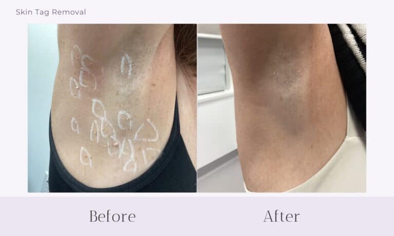 Before and after skin tag removal from under arm at Healthy Skin Centre
