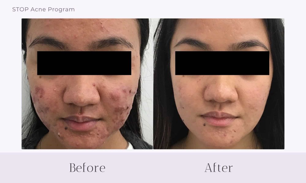 Before and after Acne treatment on face at Healthy Skin Centre