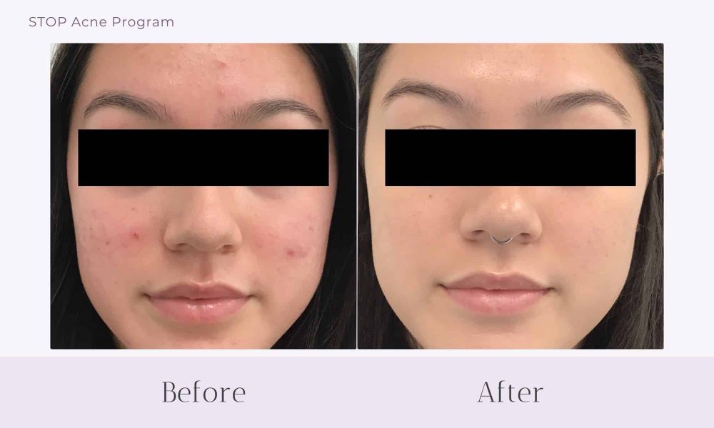 Before and after Acne treatment on face at Healthy Skin Centre