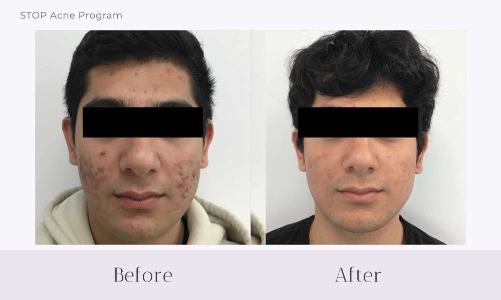 Before and after Acne treatment on face at Healthy Skin Centre