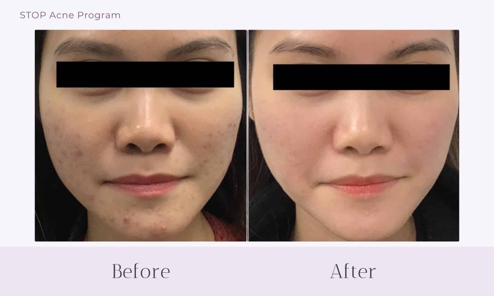 Before and after Acne treatment on face at Healthy Skin Centre