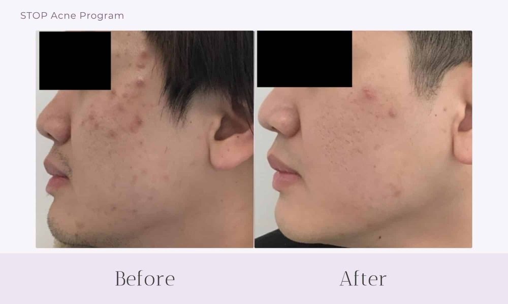 Before and after Acne treatment on face at Healthy Skin Centre