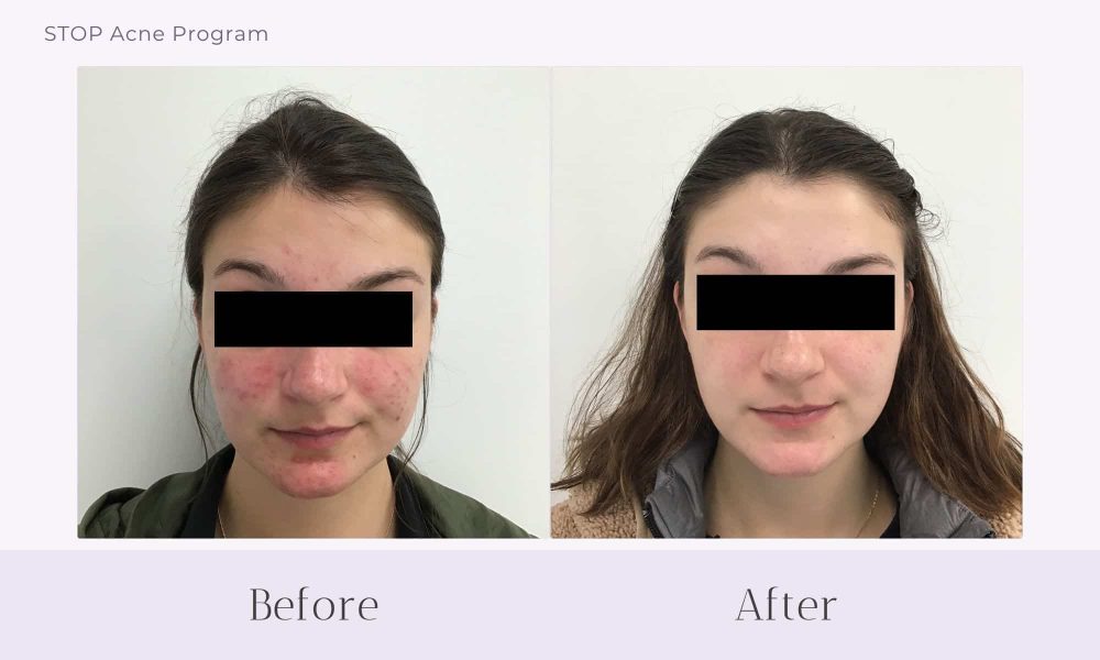 Before and after Acne treatment on face at Healthy Skin Centre